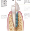 インプラント治療について
