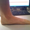 What Causes Over-Pronation Of The Foot