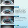 Lasik Eye  Surgical Treatment  Threats: Suction Eye Ring Intralase