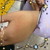 【皮膚科】皮膚科へ行く