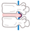 坐骨神経痛の原因は椎間板ヘルニアでした 2