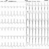 ECG-087：answer