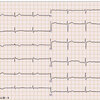 【コラム-022】正常心電図06＝(18誘導+1 &amp; Cabrera誘導)：25才女性。