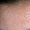 【よくある皮ふ疾患】汗管腫syringomaの治療