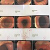 大腸検査 その結果