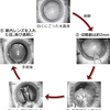 「白内障」  手術普及、眼内レンズ豊富に