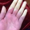 Raynaud 現象