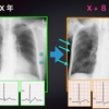 ECG-179：answer