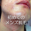怖くないし痛くない！実体験から解説する初めてのメンズ脱毛