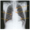 51回PT　午前問題8　正常な胸部エックス線写真を下に示す。 番号と解剖学的名称の組合せで正しいのはどれか。