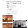116回歯科医師国家試験【116C-72】歯冠補綴学：抜歯する？しない？編