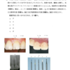 113回保存修復振り返り　グラスアイオノマーセメント編