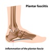Mortons Neuroma Overview