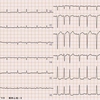 ECG-177：80代男性。頻脈とお薬の関係を考えます。