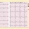 ECG-190:60才代男性。健診での心電図がQRS幅&gt;0.12秒でIRBBB???