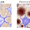 遺伝性の認知症