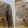 胸から腕の比較的広範囲タトゥーのインクを取ります