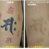 腕のタトゥーの赤と黒のインクを取っています