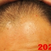 48歳にして、薄毛対策へ