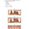 116回歯科医師国家試験【116D-81】歯冠補綴学：