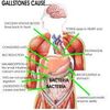 Severe Pancreatitis