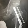30代の大腿骨頸部骨折記録12〜一か八か〜