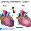 Heart Bypass Surgery in India | Coronary Bypass Surgery in India