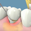 Lấy cao răng có làm trắng răng không?