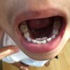 下の前歯乳歯の後ろから永久歯が生えてきた