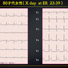 ECG-391：80才代女性。胸部不快感の出現。