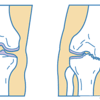 変形性膝関節症