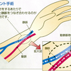 内シャントと外シャントの違い