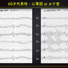 ECG-335：60才代男性。shockです。