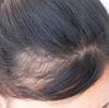 『脱毛（alopecia）を早期に発見する方法』