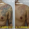 胸から腕にかけて広がる龍のカラフルタトゥーを消しました。経過写真です。