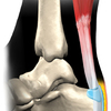 Achilles Tendinitis The Facts