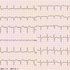 【ECG-393】頻拍発作の診断です。