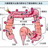 大腸憩室炎