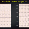 ECG-330：80才代女性。胸部不快感出現で搬入です。