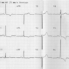 ECG-175：60才代女性。10年間での心電図変化を示しました。