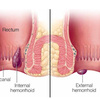 ENDOSCOPIC REMOVAL OF HEMORRHOIDS