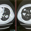 【CT結果】頭部、肺、肝臓の転移状況
