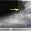 What Is A Inferior Calcaneal Spur