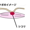 鍼と筋肉のしこり