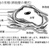 びまん性肺疾患のアプローチ～特発性間質性肺炎の診断