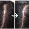ミノキシジル(ミノタブ)の二次脱毛はいつ終わる？