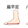 足の老化現象：偏平足とその予防法