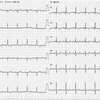 ECG-107：69才男性。入院時の心電図でした。