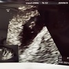 【9w2d 胎芽確認・心拍未確認】初めての妊娠、流産。アラサー主婦の記録。