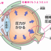 緑内障：長期的なフォローアップの重要性